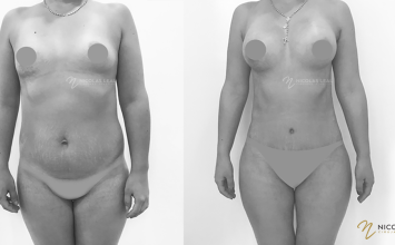 Lipoabdominoplastia