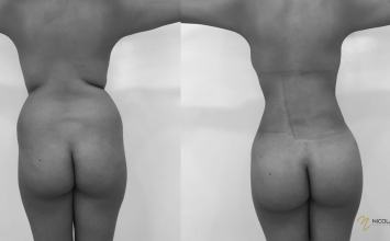 Liposucción corporal